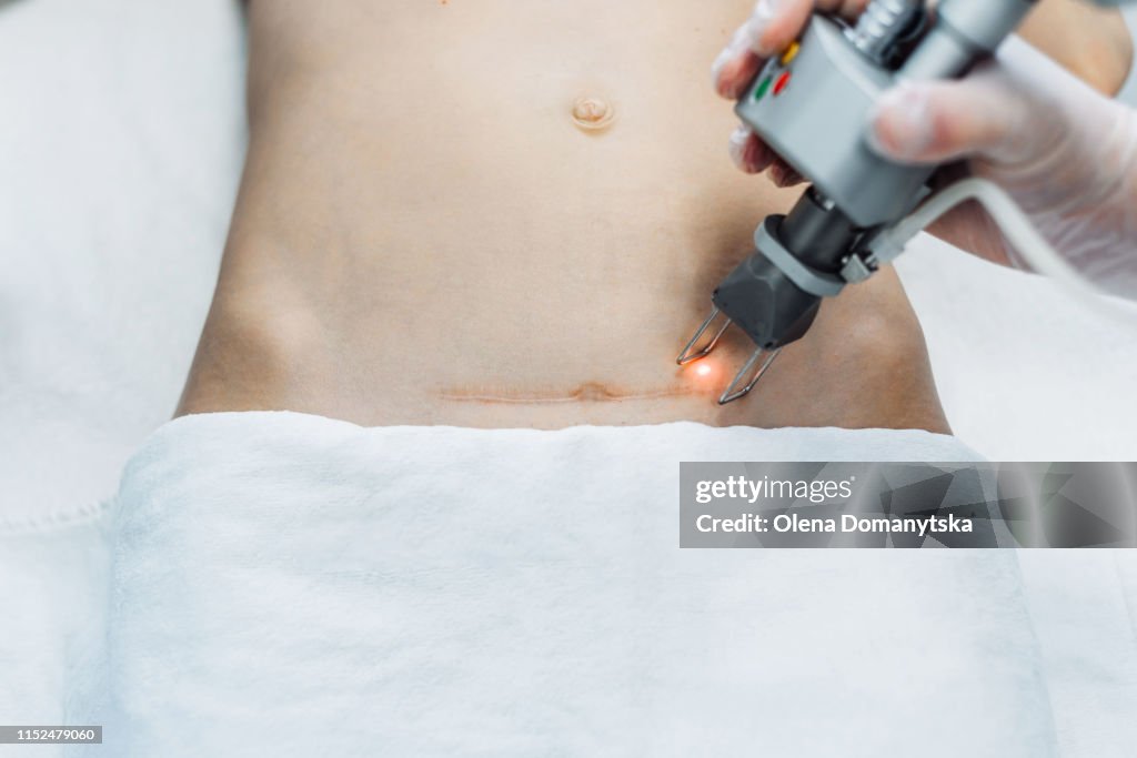 Laser correction of scar on the abdomen