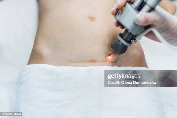 laser correction of scar on the abdomen - cicatriz imagens e fotografias de stock