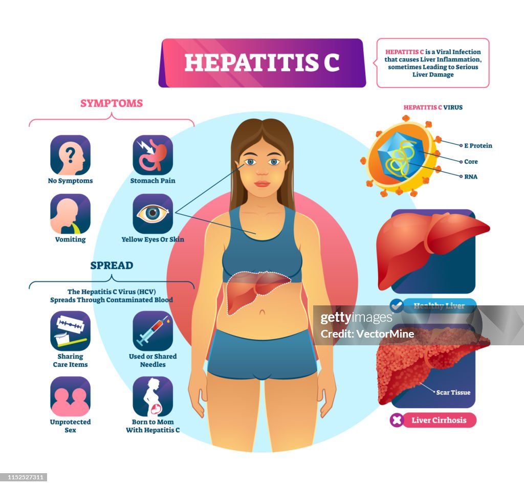 Hcv Pic Hepatitis C Vector Illustration Labeled Viral Infection Explanation ...