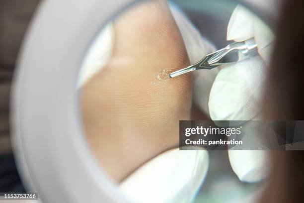 pedicura profesional utilizando máquina eléctrica para quitar las callosidades del pie - warts fotografías e imágenes de stock