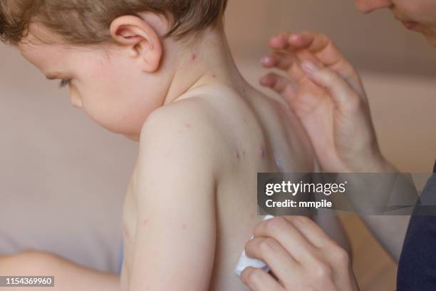 healing pox by pox - chickenpox stock pictures, royalty-free photos & images