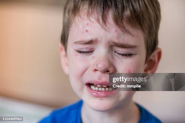 nuisance infantile - varicelle photos et images de collection