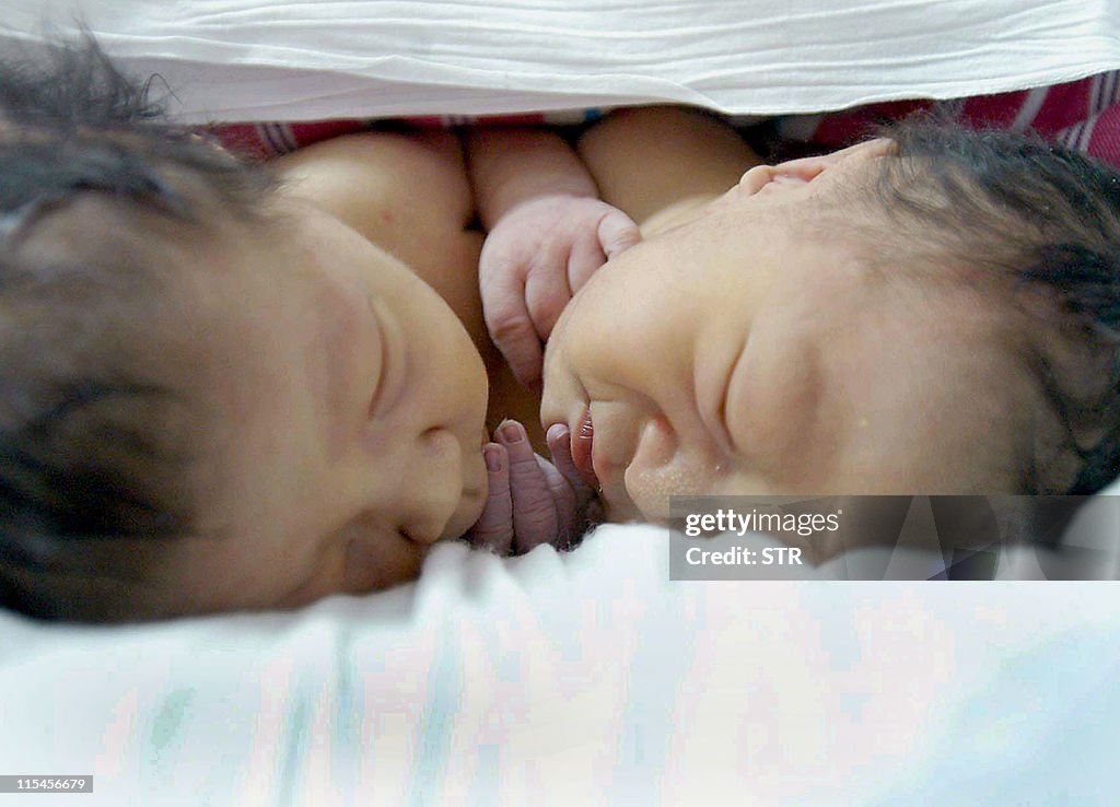 CHINA OUT
A pair of conjoint twins sleep