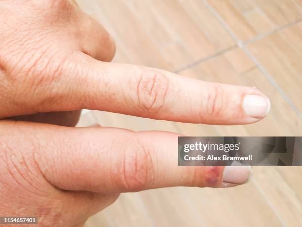 wasp sting finger - swollen stock pictures, royalty-free photos & images