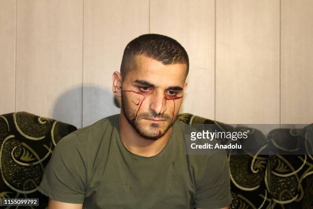 Year-old Iraqi man Mahmud Bahjat bleeding from his eyes and ears diagnosed with rarely seen disease is seen during an exclusive interview with...