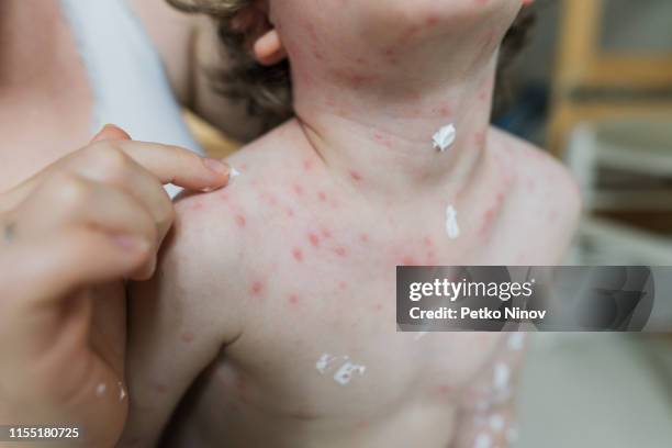 Varicell Raction Rash 388 Of Rashes On Arms Stock Photos, High-Res Pictures, and Images ...