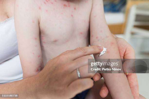 mutter behandelt varicella-hautausschlag mit sahne - chickenpox stock-fotos und bilder