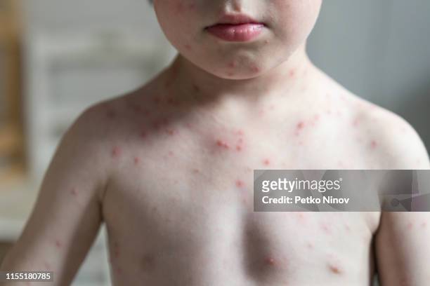 患有水痘帶狀皰疹病毒的小男孩 - chickenpox 個照片及圖片檔