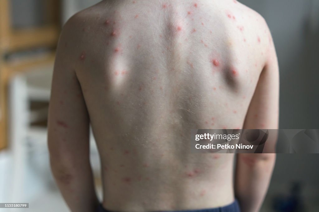 Jeune garçon avec le virus de zona de varicelle