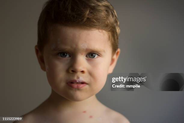 childhood difficulties - chickenpox stock pictures, royalty-free photos & images