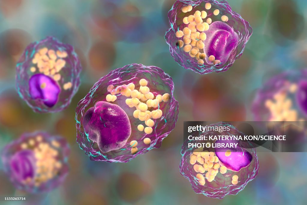 Macrophage foam cell, illustration