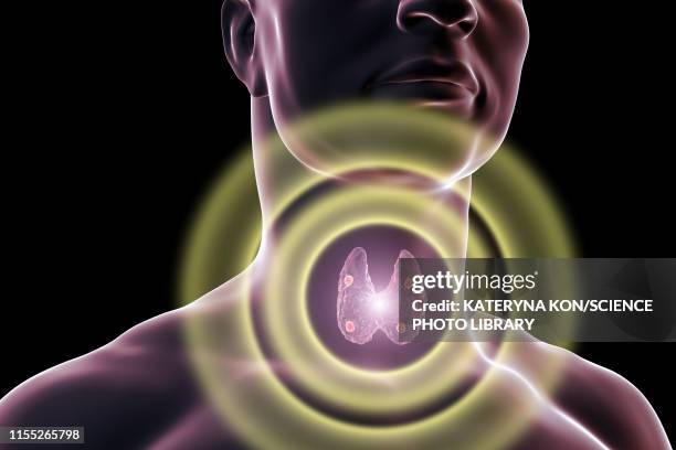 parathyroid glands, illustration - nebenschilddrüse stock-grafiken, -clipart, -cartoons und -symbole