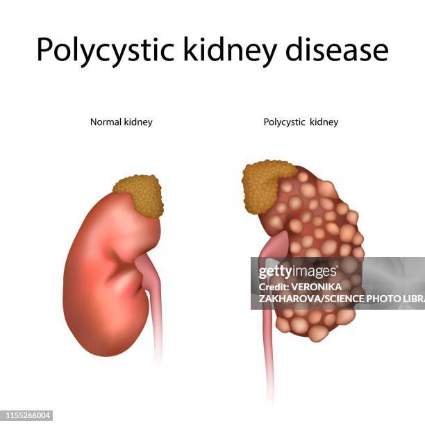 polycystic kidney disease, illustration - renal failure stock pictures, royalty-free photos & images