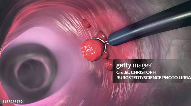 ilustrações, clipart, desenhos animados e ícones de polyp removal, illustration - intestino grosso