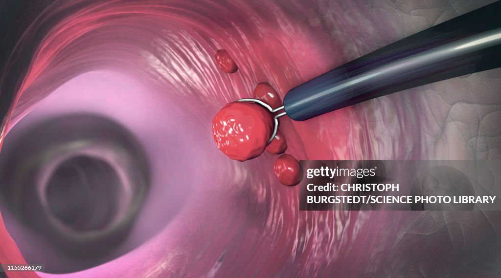 Polyp removal, illustration