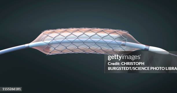 stent and balloon catheter, illustration - cateter imagens e fotografias de stock