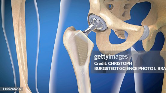 Hip replacement, illustration Hip replacement, illustration