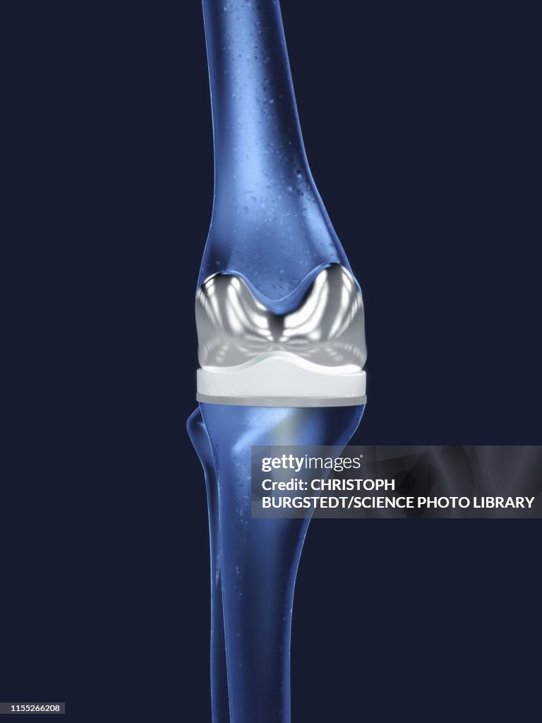 Knee replacement, illustration