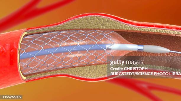 arterial stent, illustration - angioplasty stock pictures, royalty-free photos & images