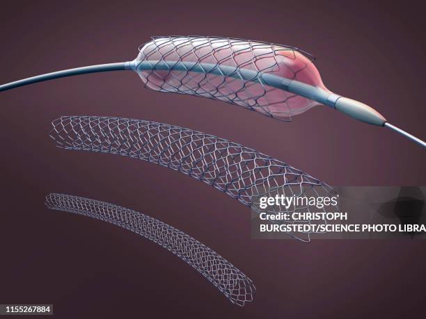 stents and balloon catheters, illustration - stent stockfoto's en -beelden