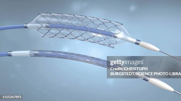 stents and balloon catheters, illustration - catheter stock pictures, royalty-free photos & images