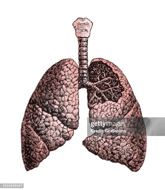 24 Ilustraciones de Tejido Pulmonar - Getty Images 24 Ilustraciones de Tejido Pulmonar - Getty Images