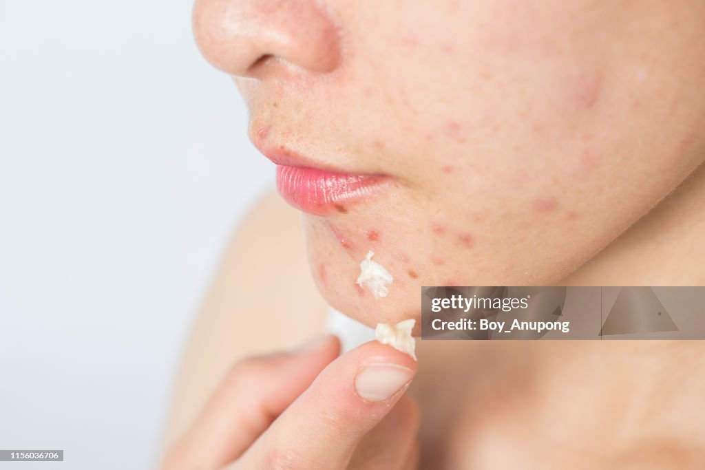 Portrait of young Asian woman having acne problem and she applying acne cream on her face.