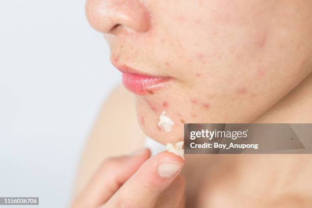 portrait of young asian woman having acne problem and she applying acne cream on her face. - applying cream stock pictures, royalty-free photos & images