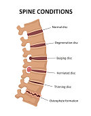 Stages of spinal osteochondrosis. Degenerative Disc. Bulging Disc. Herniated Disc. Thinning Disc