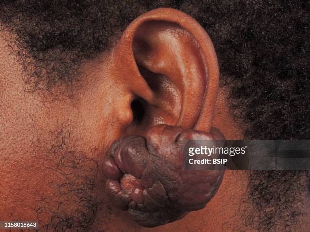 Keloid of the ear.