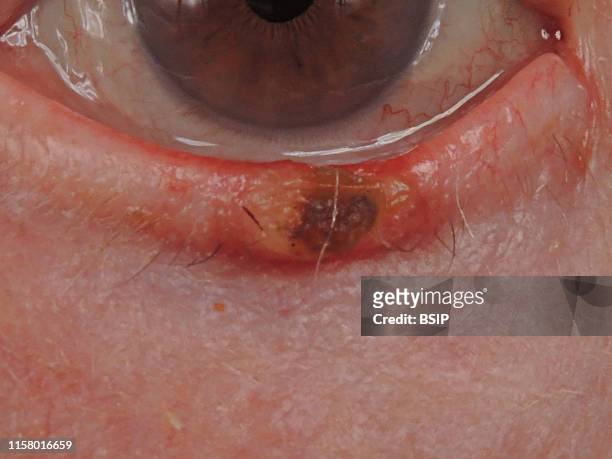 Well-differentiated invasive squamous cell carcinoma developed on a keratoacanthoma of the lower eyelid.