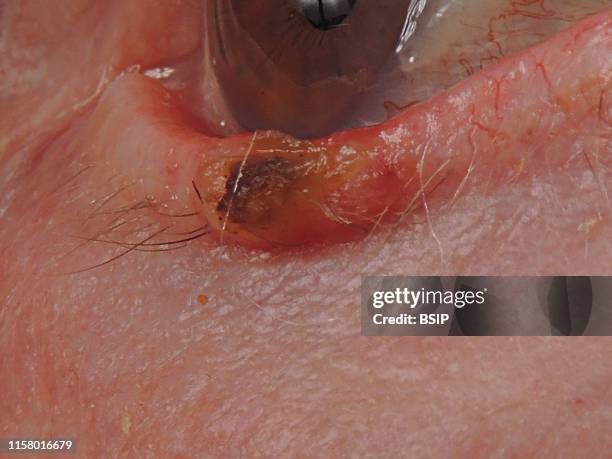 Well-differentiated invasive squamous cell carcinoma developed on a keratoacanthoma of the lower eyelid.