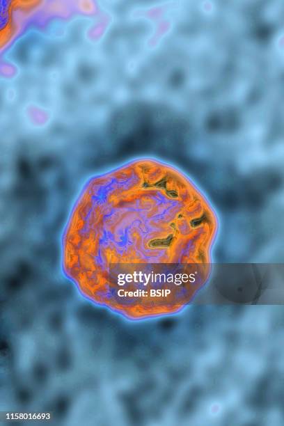 Hepatitis B virus . HBV causes sexually transmitted or blood-borne hepatitis. Cirrhosis occurs in 20% of cases 15 to 20 years after the onset of...