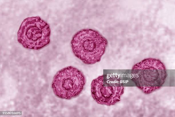 Hepatitis C virus . HCV causes blood-borne hepatitis, cirrhosis occurs in 25% of cases, 10 to 20 years after the onset of infection, with a risk of...