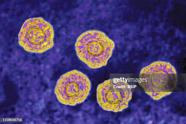 Hepatitis C virus . HCV causes blood-borne hepatitis, cirrhosis occurs in 25% of cases, 10 to 20 years after the onset of infection, with a risk of...