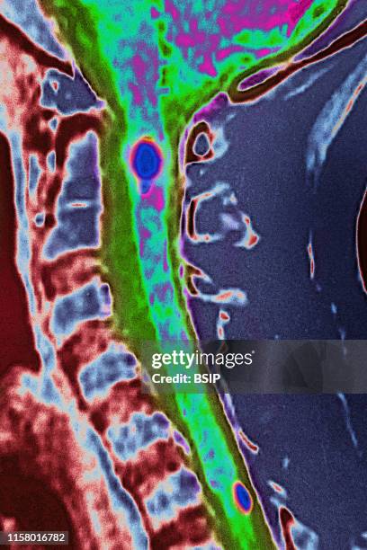 Spinal neuromas in cervical vertebrae, seen on a sagittal section MRI scan.