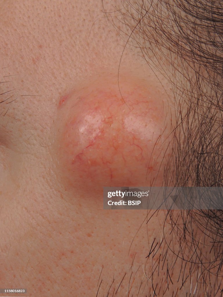 Temporal sebaceous cyst
