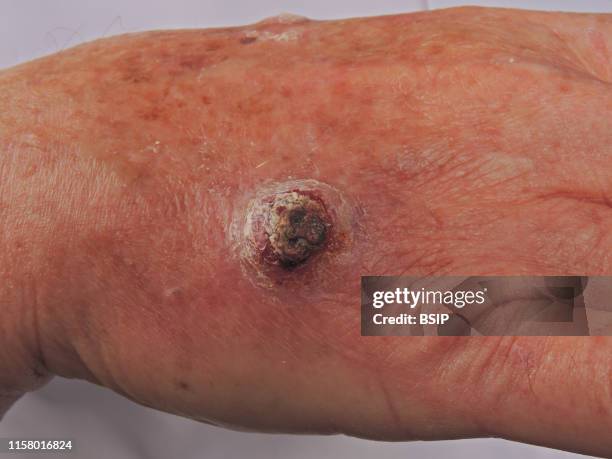 Invasive squamous cell carcinoma of the hand.