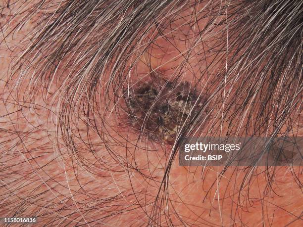 Basal cellular carcinoma of the scalp