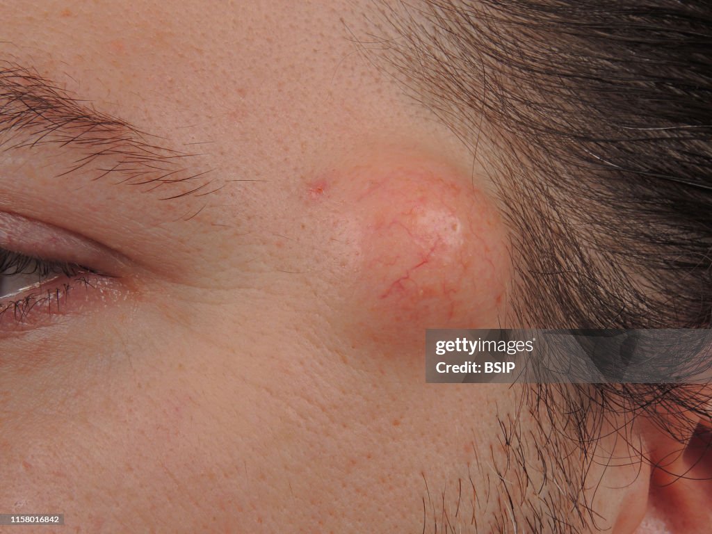 Temporal sebaceous cyst