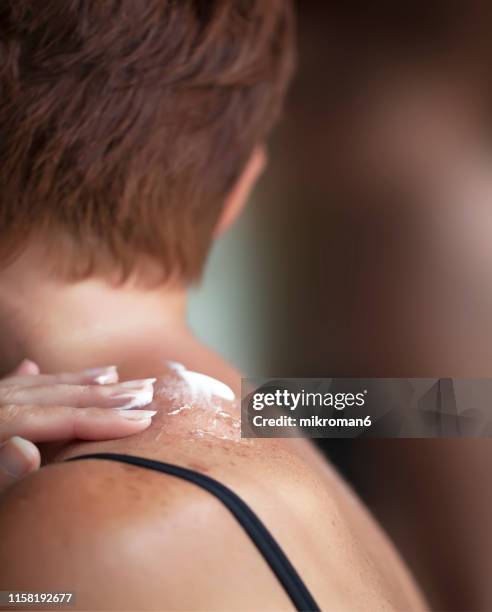 woman looking in mirror to see sunburned skin on shoulder that peeling off. - sunburned stockfoto's en -beelden