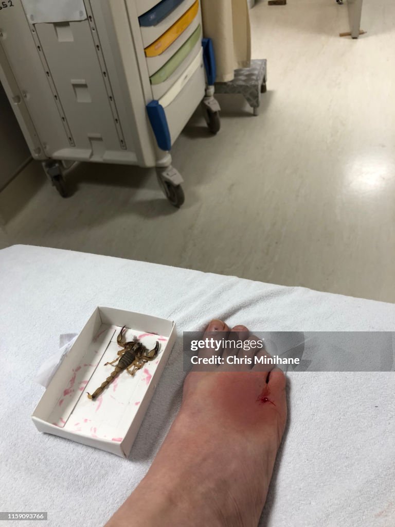Scorpion Sting on Foot