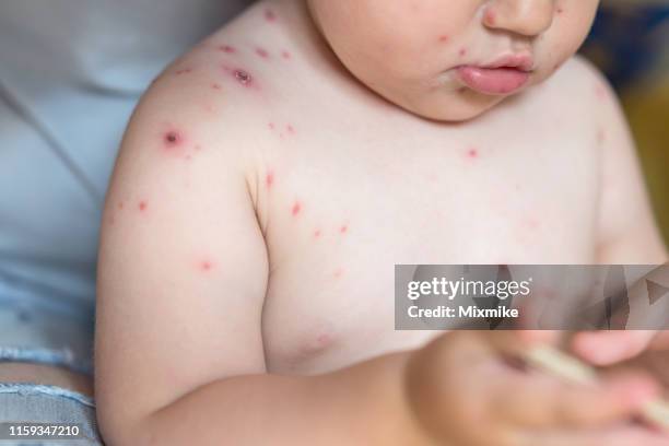 petite fille avec le virus de zona de varicella - virus pox photos et images de collection