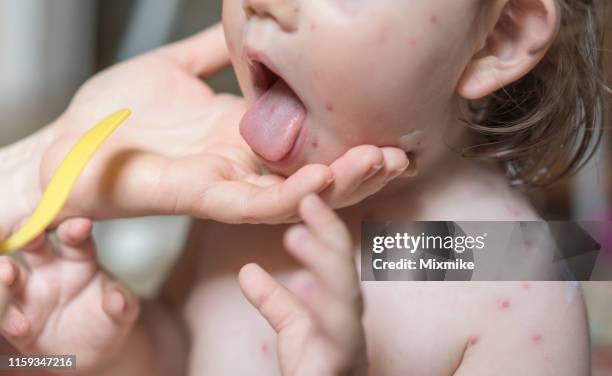 klein meisje met waterpokken bij de artsen - hand uitsteken stockfoto's en -beelden