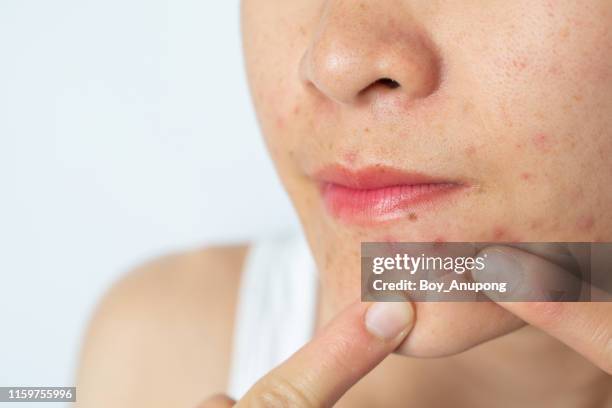 close-up of woman half face with inflamed acne on her face. - cyst stock-fotos und bilder