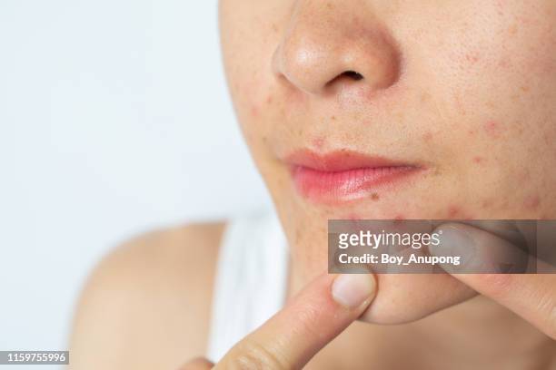 close-up of woman half face with inflamed acne on her face. - cyst bildbanksfoton och bilder