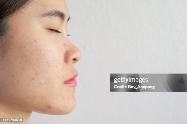 side view of woman face with inflamed acne on her face. - cyst stock-fotos und bilder