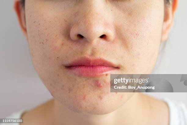 closeup of woman half face with problems of acne inflammation (papule and pustule) on her face. - berucht stockfoto's en -beelden