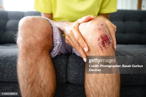 man holding his bruised / injured / wounded knee - cardenal lesión física fotografías e imágenes de stock