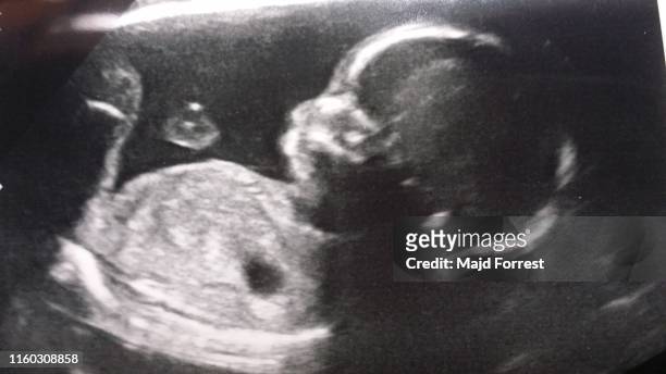 baby scan - ultrasound stockfoto's en -beelden